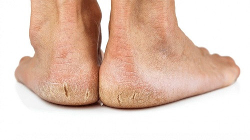 dry feet treatment