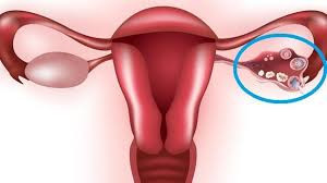 ovarian cyst cancer risk