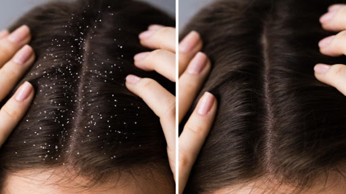 Home Remedies to Cure and Control Dandruff