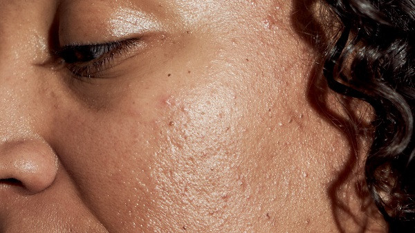 Winter Skincare for Acne